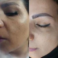 درمان لک صورت تضمینی