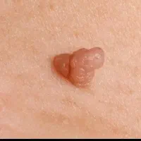 زگیل زیگیل خال ذگیل تناسلی hpv میخچه بواسیر hsv