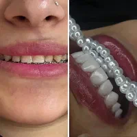 کامپوزیت ونیر ۴۰درصد تخفیف فقط ۳روز برای ۵نفر