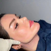 ساکشن غبغب ، لیفت با نخ و کانتورینگ صورت