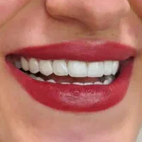 جشنواره تکرار نشدنی کامپوزیت و بلیچینگ دندان