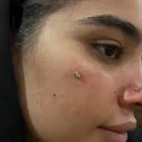 پیرسینگ  میکرودرمال تاتو چال گونه توسط پزشک