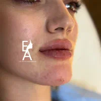 تزریق تخصصی توسط دکتر (فیلر بوتاکس جوانسازprpمزومو