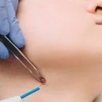 زگیل خال زیگیل تناسلی میخچه hpv تبخال hsv ذگیل