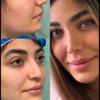 عمل جراحی بینی 40%تخفیف (رینوپلاستی)در کرج