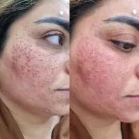 صافی مو کراتین وپروتین وخال برداری