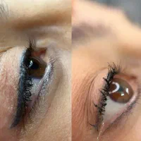پاک کردن تتوهای خراب صورت در یک جلسه