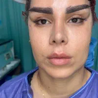 تزریق چربی باسن