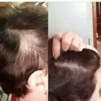 قطع ریزش مو فقط  تو سه هفته