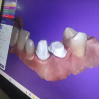 آموزش دندان سازی دیجیتال با اگزوکد و دستگاه میلینگ