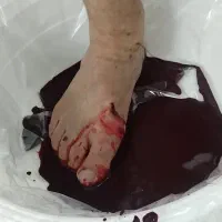 حجامت. فصد. زالو درمانی