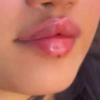 تزریق ژل وبوتاکس با مدرک  900