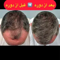 ریزش مو را کاملا طبیعی کنترل کنید با بهترین قیمت