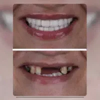 دندانپزشکی/ ترمیم/عصب کشی/ پرکردن/ روکش