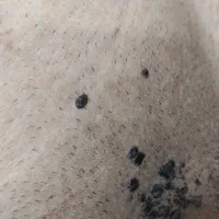 درمان تخصصی زگیل تناسلی باتضمین بدون بازگشت