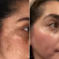 با کمترین هزینه تمام مشکلات پوستیت و از بین ببر
