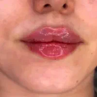 تزریق ژل لب،مزوژل،بوتاکس،فیلر بادی