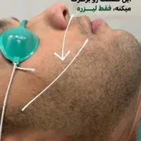 لیزر،هایفو،پی آرپی،بوتاکس،آراف فرکشنال