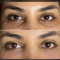 خدمات زیبایی / اصلاح فرم بینی / گودی زیر چشم