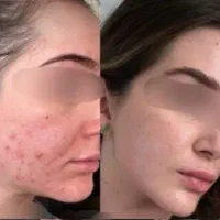 پاکسازی پوست صورت خودتون به من بسپارید