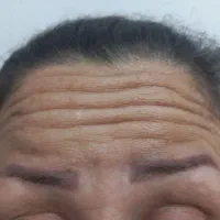 تزریق فیلر و بوتاکس. کاملا بهداشتی و استریل شده