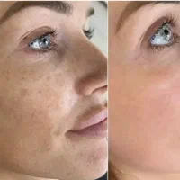 ریموکک ومک فشیال تخصصی صورت