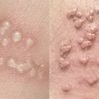 رفع قطعی ریشه ای زگیل و تبخال تناسلی
