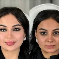 کلینیک تخصصی هایفو ژل نخ بی رقیب آموزش بوتاکس ژل