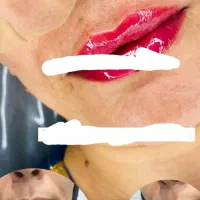 تزریق و آموزش ژل،بوتاکس،آنزیم، مزو ژل و پی ار پی