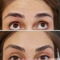 بوتاکس