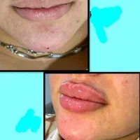 تزریق ژل وفیلر و بوتاکس و جوانساز  انزیم وچالگونه