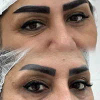 (کاشت ابروی طبیعی) اقساط چندین مرحله ای