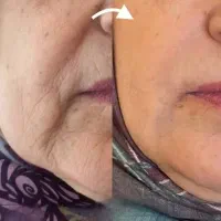چین و چروک