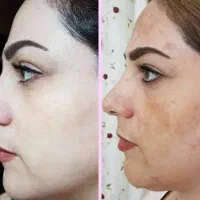 خدمات تخصصی فیشیال پوست فقط با 500هزار تومان