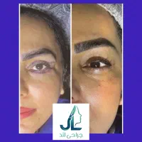 بلفارو پلک و چشم گربه‌ای + اقساطی با مشاوره رایگان