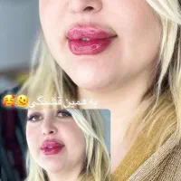 تزریق ژل فیلربوتاکس تخفیفات50درصدی برای زیباجویان