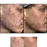 درمان جوش و جای جوش لک (بدن و صورت)و ریزش مو