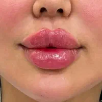 مطب زیبایی مزو.بوتاکس.فیلر