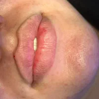 ژل بوتاکس