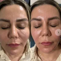 چشنواره مخصوص عیدانه فیلر و بوتاکس