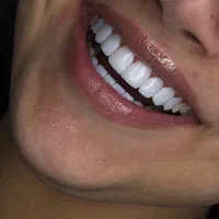 کامپوزیت دندان قسطی اقساط بدون پیش پرداخت