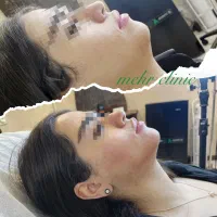 افر بهاره ژل،فیلر،لاغری بوتاکس،کانتورینگ و لب