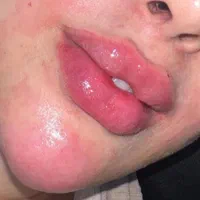 ژل لب و صورت بوتاکس