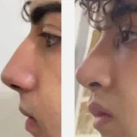 لیفت کوچک کننده بینی در ۲۰ روز