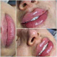 آف ژل/بوتاکس/فیلرهایفو/نخ/جوانسازتوسط پزشک