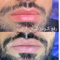 روشن سازی لب نچرال ، اسکالپ سر ، فیبروز ابرو نچرال