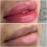 تخفیف شیدینگ لب تخصصی(٪۱۰۰ بدون درد )