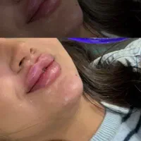 تزریق ژل و بوتاکس