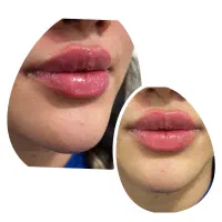 انواع خدمات ژل وبوتاکس