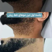 لیزر رایگان/آقا/خانم/باقویترین دستگالیزرموزائد۲۰۲۶